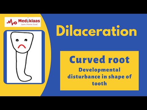 Dilaceration l Developmental tooth alteration l Oral pathology l Mediklaas