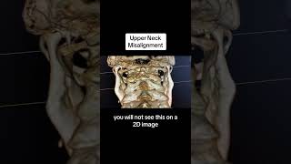 Upper Neck Misalignment Utilizing Advanced 3D Spinal Imaging via CBCT