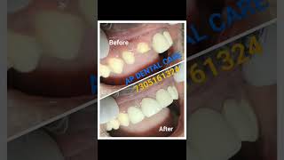 Front teeth smile correction pictures #smilecorrection