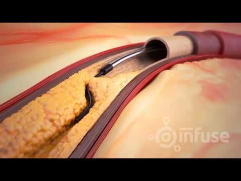Artery Blockage
