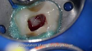 MTA pulpotomy – Video abstract ID 134315