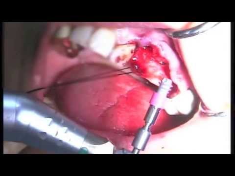 Placement of the Implant (6.5 Short Implant)