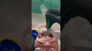 Porcelain Veneer Delivery Day Workflow