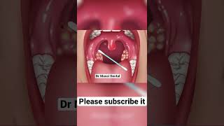 What causes bad breath/halitosis?
