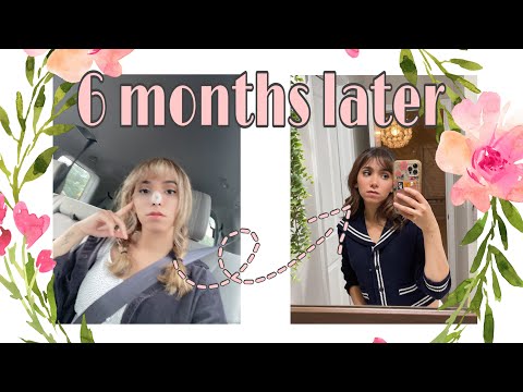 nose job update | 6 months after surgery