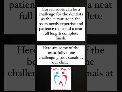 "Mastering Curved Root Canals: Smiles Royale's Expertise Unveiled!"  #SmilesRoyale#CurvedRootCanals
