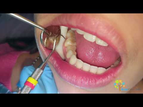 Molar Cavity Filling with Composite