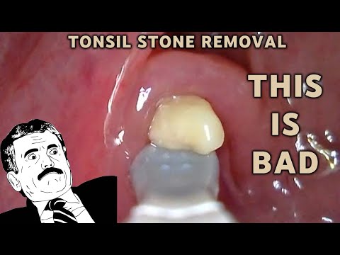 IT GETS BAD - Tonsil stone removal | AIM 19