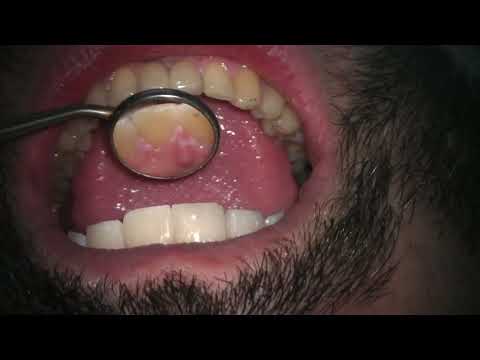 Repairing Chipped and Worn Teeth Using Bonding