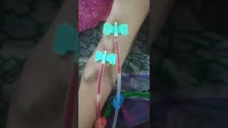 #dialysispatient #patient #treatmentforallbodyparts #shortvideo #viralshorts #