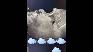 #baby #baby #ultrasound #babyultrasound #pregnant #lifeisbutadream #pregnancyscan#babygirl #babyscan