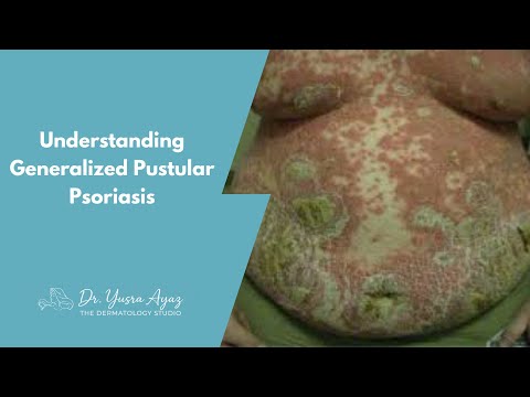 Lecture 6: Generalized Pustular Psoriasis Explained: Types, Clinical Presentation and Management