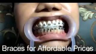 Affordable and Cheap Braces [FASHION Innovation]