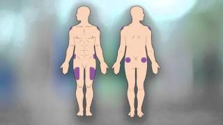 How to Give Yourself an Intramuscular Injection
