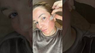 QURE SKINCARE MY 5 MONTH MICRO INFUSION SYSTEM REVIEW #qureskincare #microneedling #qure