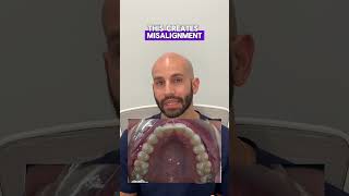 Invisalign Smile Design to Straighten Upper Front Teeth