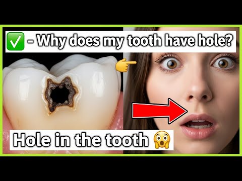 ✅ Why does my tooth have a hole? / Hole in the tooth 👈😳