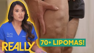 Dr. Lee Helps Patient With 70+ Lipomas | Dr. Pimple Popper