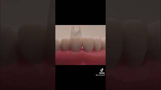 #smile #teeth #smilemakeover #bioclear