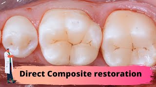 Deep margin  composite direct restoration