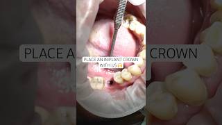 How it’s done: Placing an implant crown 🙌 #newsmile #dentalimplant #implant #compositeveneer