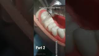 Crown Preparation​ 🦷 (Part 2) #dentist​#dental #crown #prosthodontics