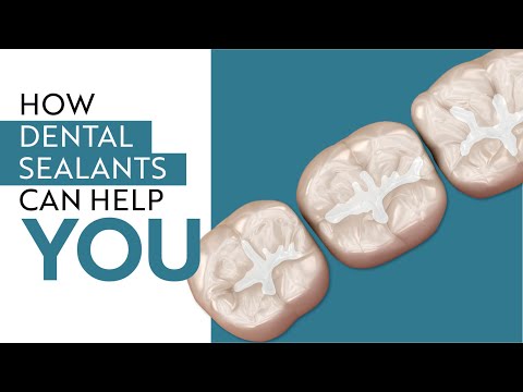 Are Dental Sealants Necessary?