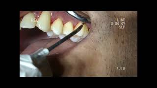 LANAP for gum strengthening treatment #drshaiksdentalclinic #chennaidentist #laserspecialist