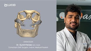 Full-arch Maxillary Rehabilitation using Patient-Specific Implants | Dr. Sumit Patidar (OMFS)