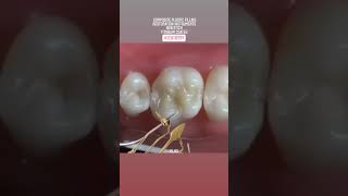 Composite filling instruments | Tooth filling | Smile make over
