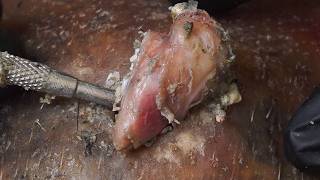 Watch Dr. Lee Remove Giant Blackheads in HD – Deep Pore DHB328655