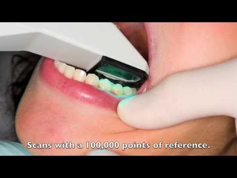 iTero - The Digital Impression Scanner