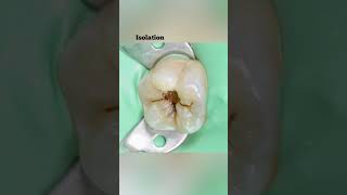 Molar tooth filling | case 26 | Detailing tooth structure |Your Dentist  #shots #shortvideo #shorts
