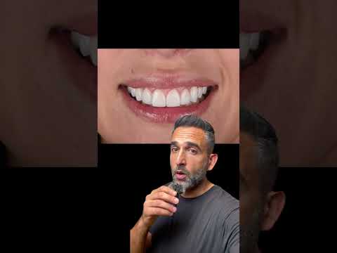 How to transform a smile using veneers #shorts #veneers