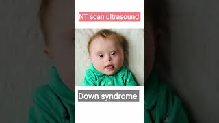 How is NT SCAN done, Live Demo / Why is NT ultrasound necessary during pregnancy.