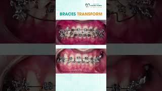 Braces Transform #shorts #dentist #dentistry #braces #orthodontist