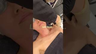 Post laser skin treatment routine for fast recovery @clinique #CliniquePartner #Skincare