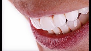 Intraoral scan Smile Design & eMax CareStream CS3600 digital impression
