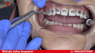 Getting Braces at 25?! See What Really Happens on Day 1 😬 #bracestransformation #dentealvideo