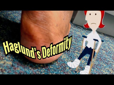 Foot Surgery-Mental Preparations #Haglaundsdeformity#footsurgery#footproblems
