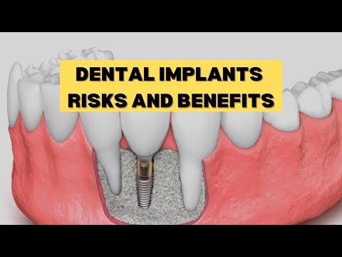 Dental Implants | Types, Benefits, and Risks