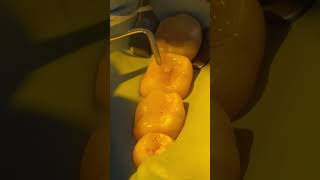 Direct Composite Restoration #readdescription #dentist #biomimetic