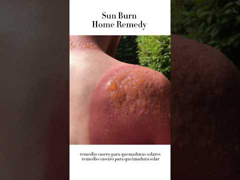 Sun burn effective home remedy #youtubeshorts #remedies