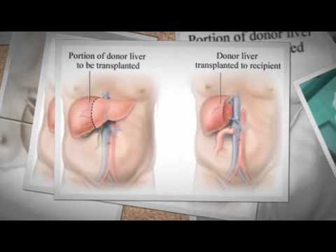 Organ Donation and Liver Transplant