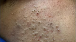 Deep Facial Cleansing | Acne Treatment & Blackhead Removal Tips