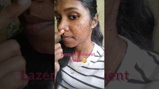 My lazer treatment days🥺🙂( warts remove) #treatment #viralvideo #