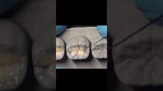 Dental motivation. Composite modeling anatomy teeth. #dental #dentistry #dentaltreatment