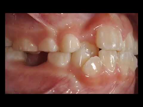 Transformation Tuesday! Leone & Vaughn Orthodontics