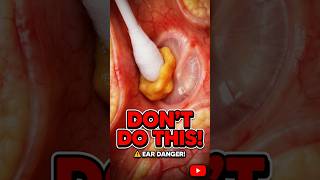 STOP Using Q-Tips! Your Eardrum Will PUNCTURE! 😱👂