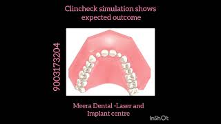 Closing the gap in between front tooth with aligners #chennaidentist